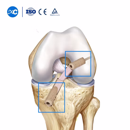 វីស PEEK Suture Anchor Screw (ACL/PCL)