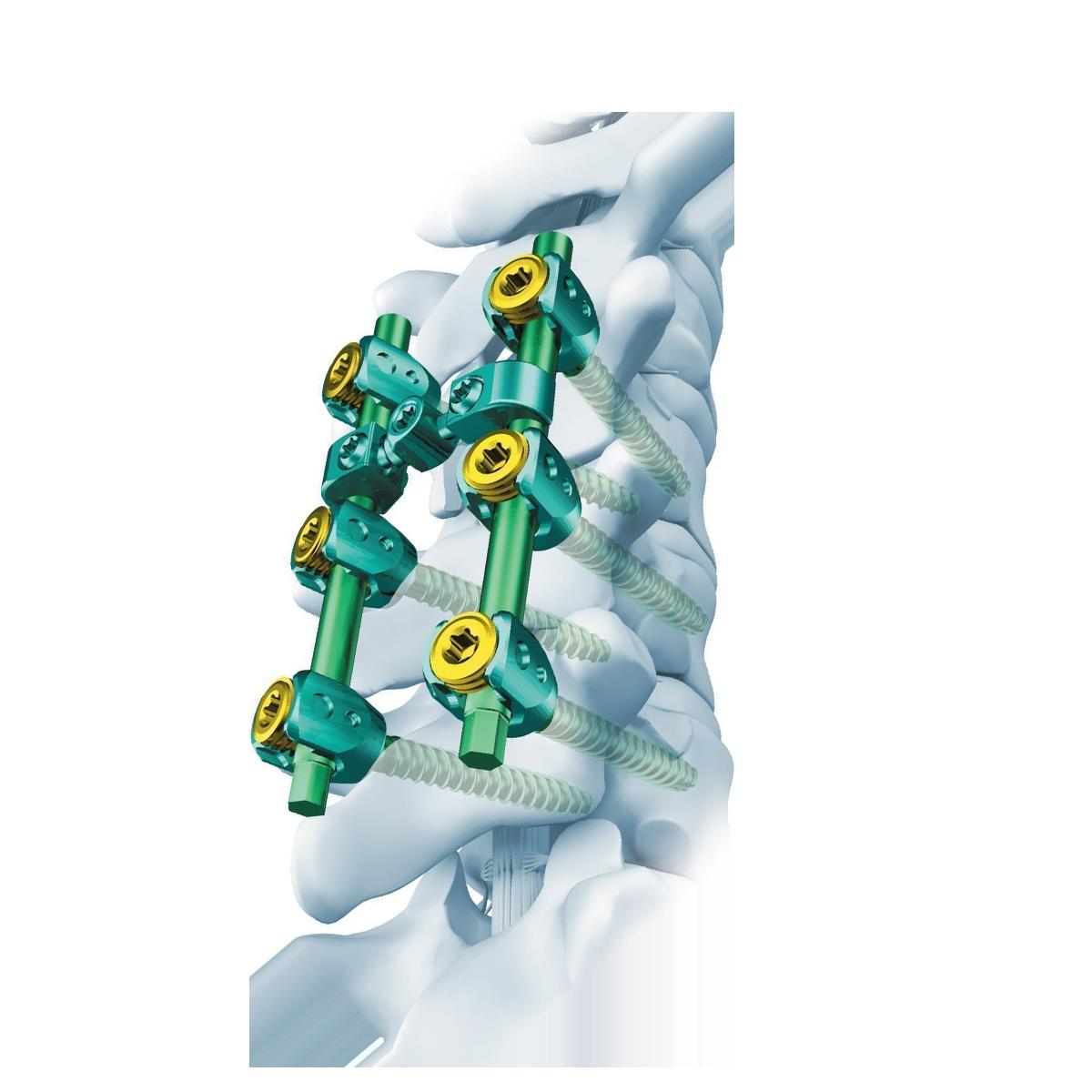 &iquest;Cu&aacute;ndo es necesaria la fusi&oacute;n de la columna cervical?