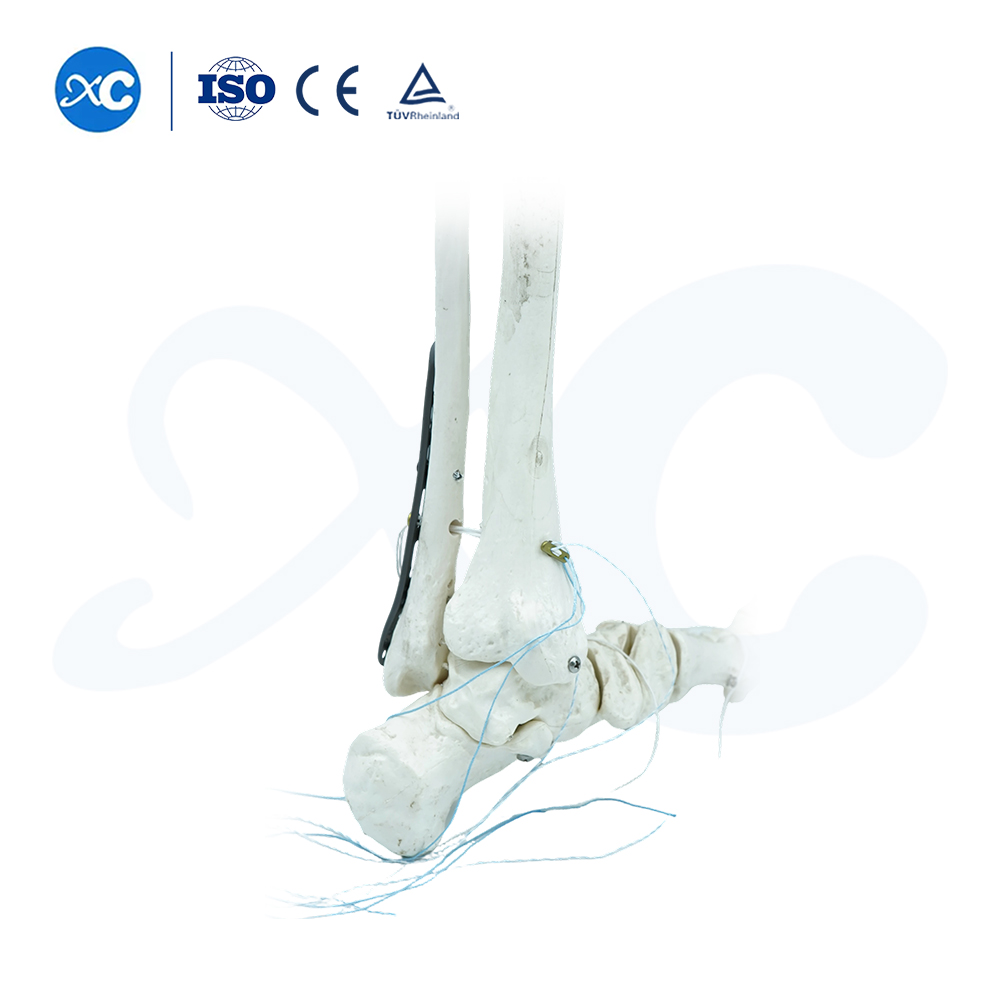 Plat Pengunci Tibiofibuler Distal-III - Beli Produk di XC Medico