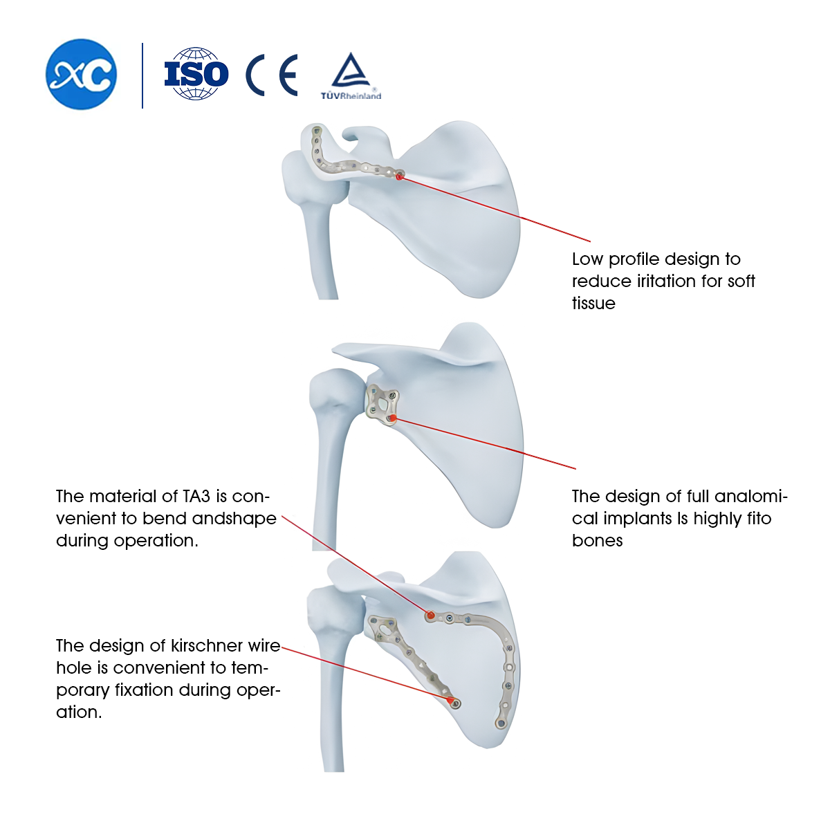 Placa de bloqueo de esc&aacute;pula para fijaci&oacute;n de fracturas de om&oacute;plato | XC M&eacute;dico -2