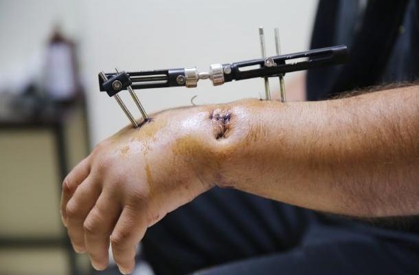 Wawasan Teknikal: Aplikasi Klinikal & Prestasi Pembetul Luar