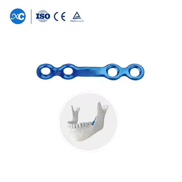 2.0 Retromolar Triangle Alveolar Ridge Locking Plate