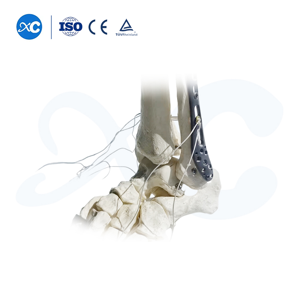 Plat Pengunci Tibiofibuler Distal-III - Beli Produk di XC Medico