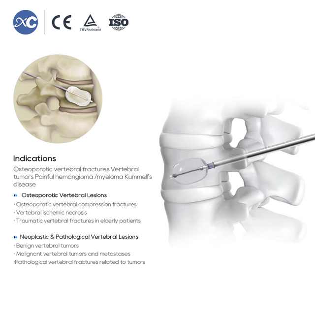 Sistema de Kifoplastia (PKP) | Globo Vertebral & Kit de Cemento