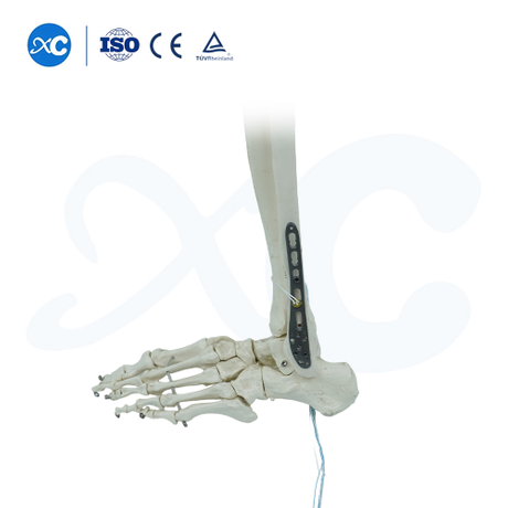 Placa de bloqueig tibiofibular distal-III