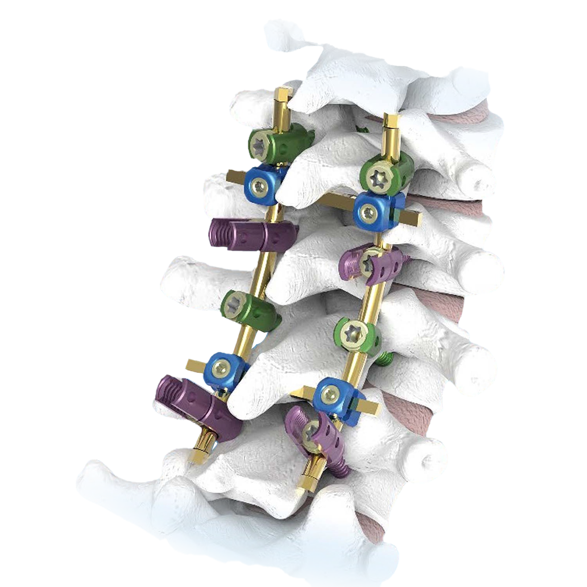 L'espina b&iacute;fida &eacute;s una alteraci&oacute; ortop&egrave;dica?