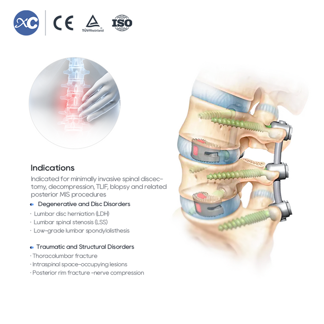एमआईएस स्पाइनल पोर्टल इंस्ट्रूमेंट सेट - एक्ससी मेडिको पर उत्पाद खरीदें |
