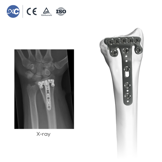 Distal Radius Volar Multi-axial Locking Plate | Fametrahana Orthopedic Titanium & Fixation Fracture