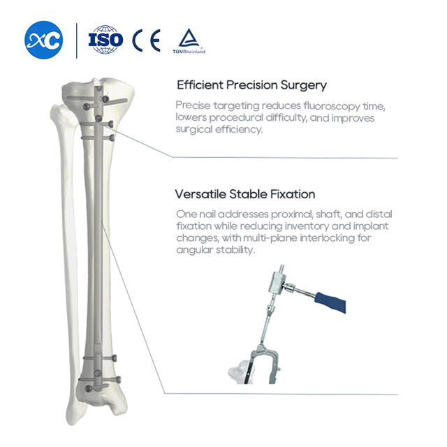 Tibia thar Intramedullary Nail | Orthopaedic Fixation chungchang | XC Medico chuan a rawn ti a