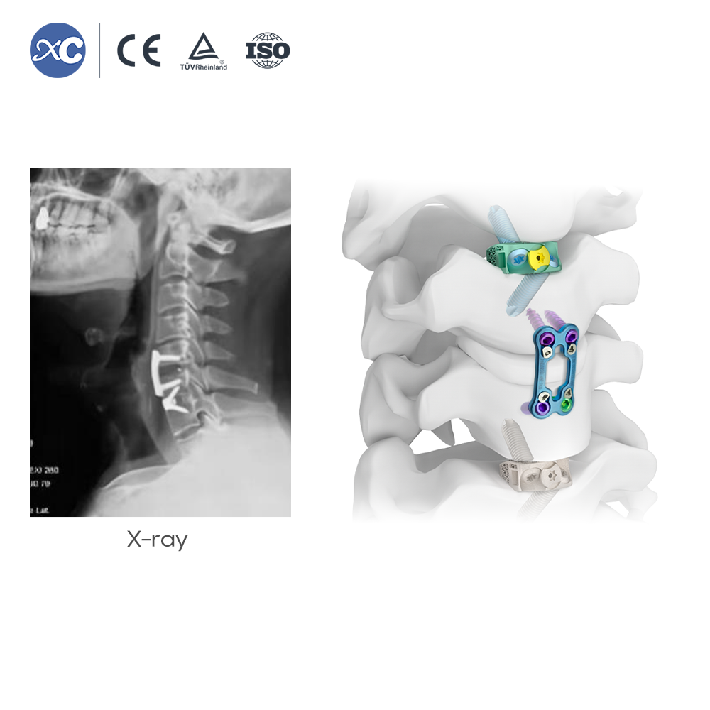 Cervical Retractor Instrumentsett | ACDF kirurgi | XC Medico