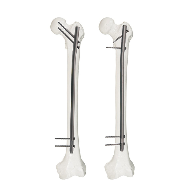 I-Femoral Reconstruction I-Intramedullary Nail yokuLungisa i-Femoral Fracture Fixation | XC Medico