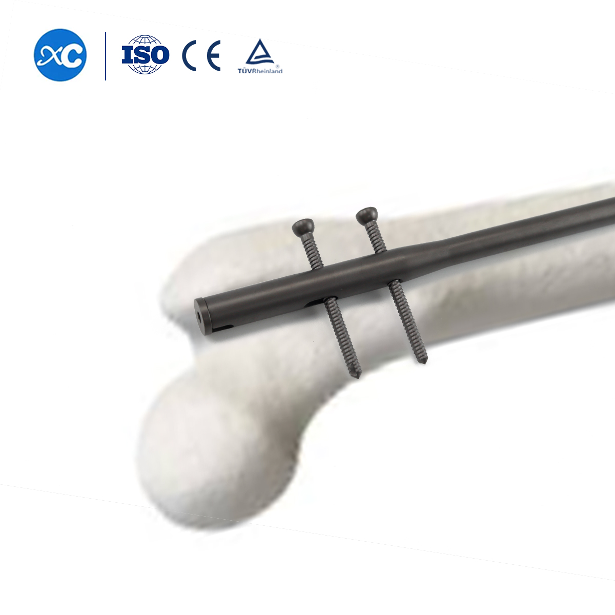 ʻO ka hoʻonohonoho hoʻonohonoho hoʻopaʻa paʻa kokoke o RG2SD nail femoral