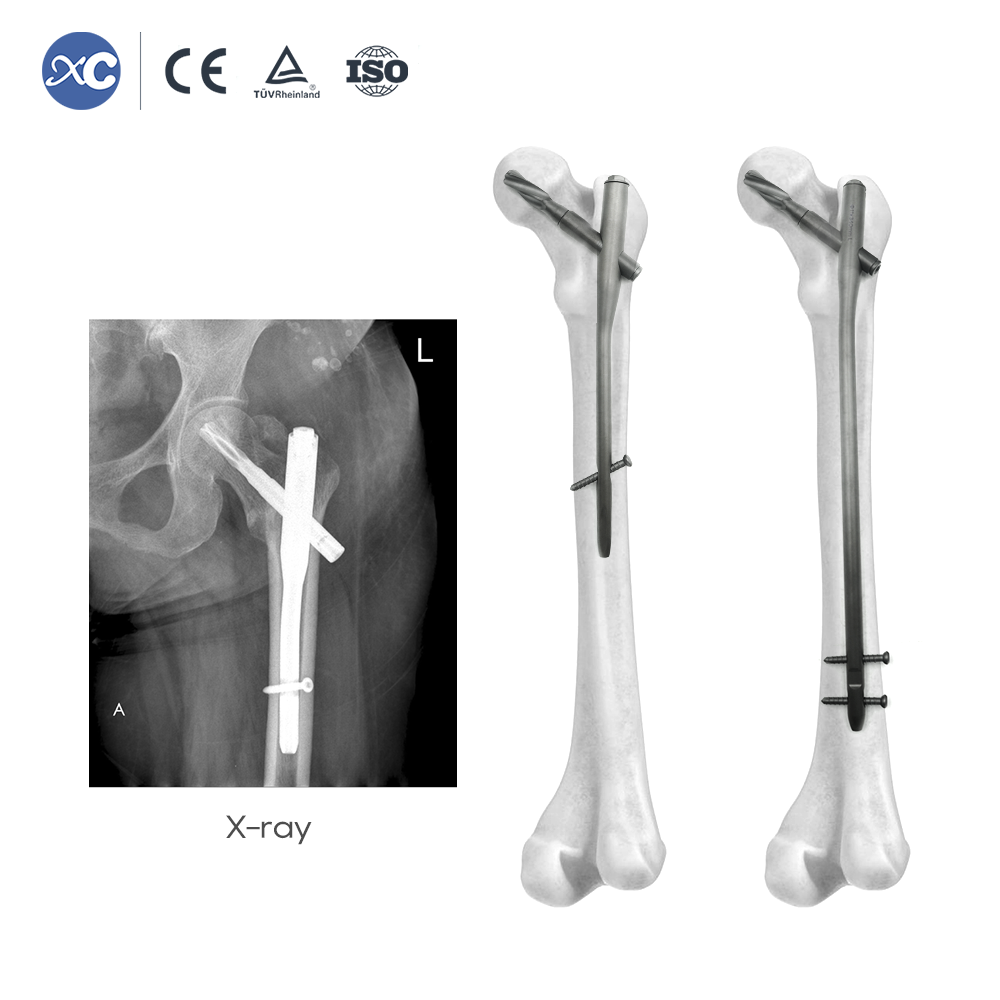 PFNA Intramedullary Nail | Proximal Femur Fracture Fixation