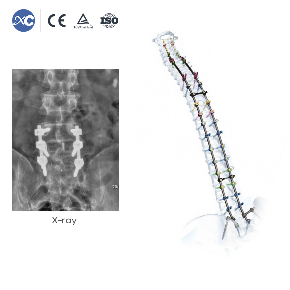 MLD Հոդակապ հետ քաշող հավաքածու | Micro Lumbar Discectomy գործիքներ