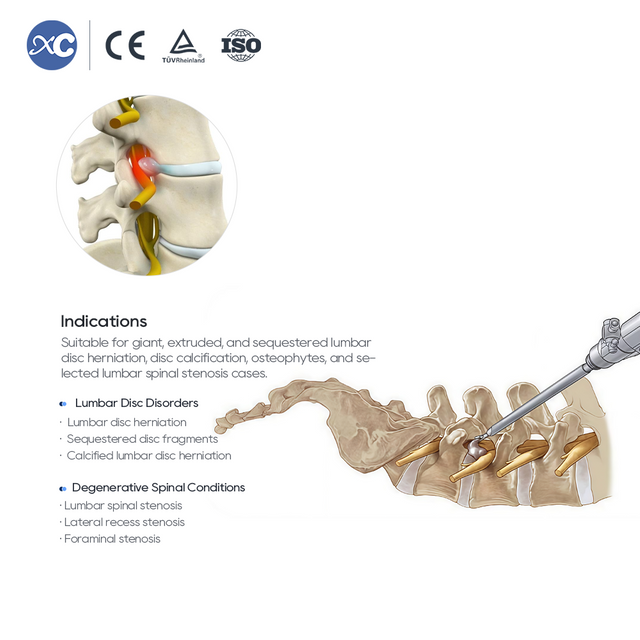 Transforaminal Endoscopic 10.0 hmanraw hman tur siam | XC Medico chuan a rawn ti a