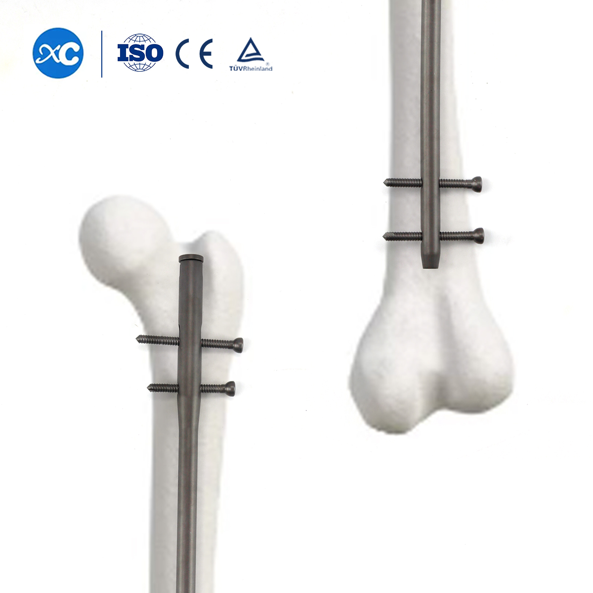 ʻO ka paʻa ʻana o ka nail intramedullary femoral