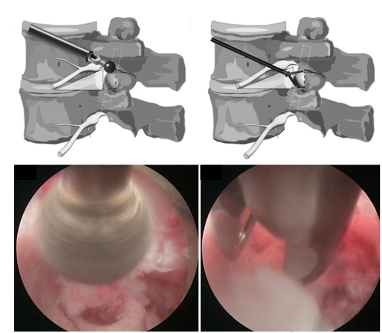 Uvimbe wa Pamoja wa Uso wa Lumbar Wenye Mfinyizo wa Mizizi ya Mishipa ya L5: Mapitio ya Kesi ya Mtengano wa Endoscopic